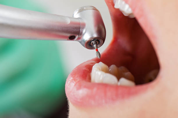 Best Emergency Wisdom Teeth Removal in Dallas, GA